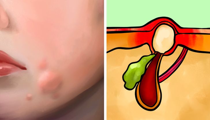 Cysts